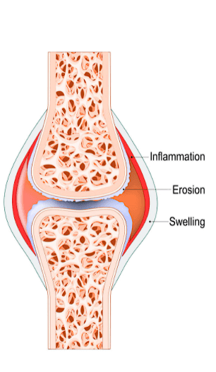 Bad Knees